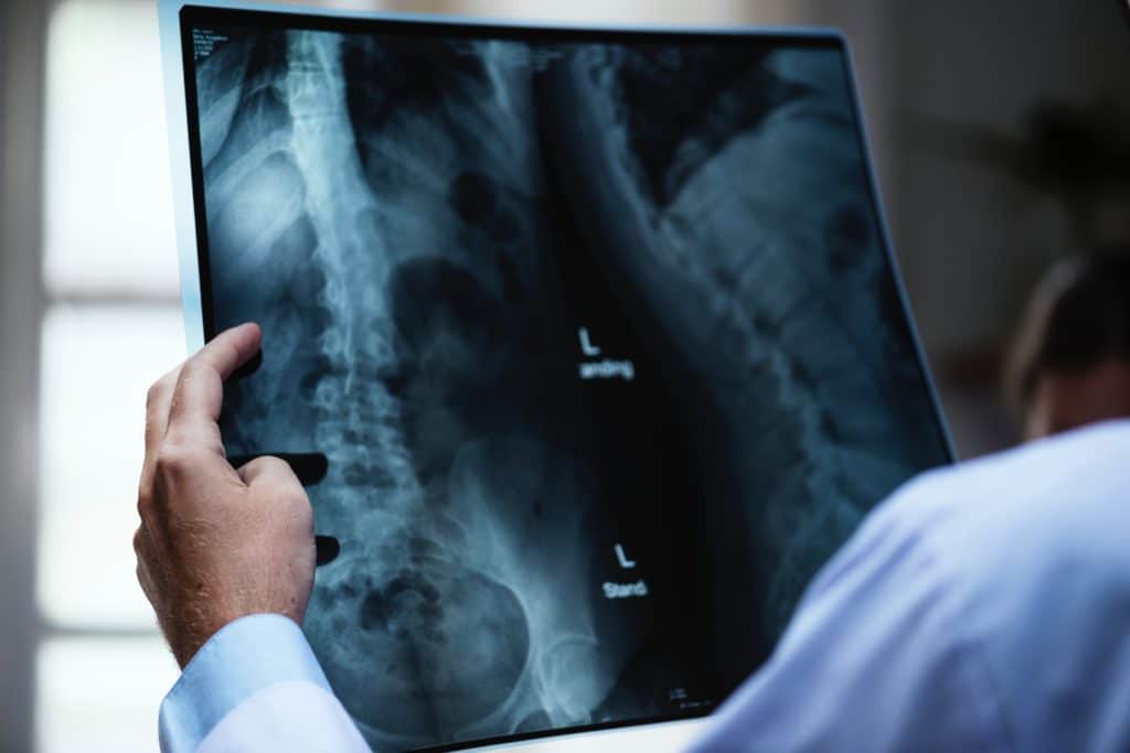 Physician looking at x-rays of a spine
